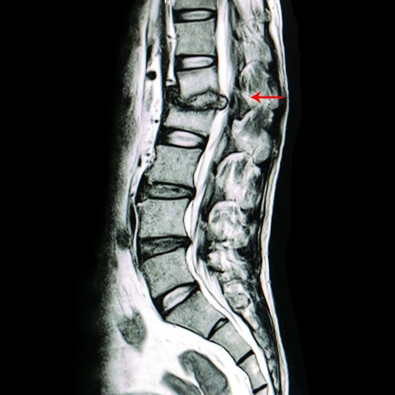 MRT-Bild eines Bandscheibenvorfalls in der Lendenwirbelsäule